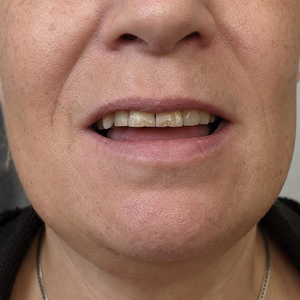 Slijtage en verkleuring hersteld — voor de behandeling